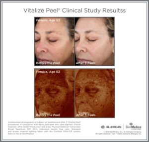 Before & After photo - reduced blemishes and lines after Vitalize Peel
