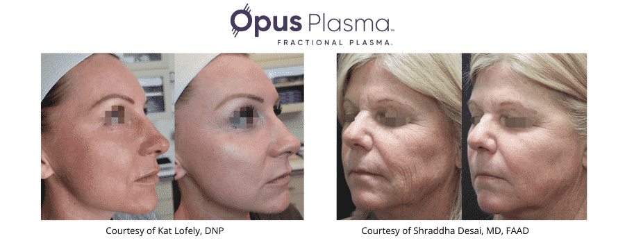 Skin Resurfacing Game Changer – Opus Plasma
